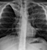 pcp nipple ring chest x-ray