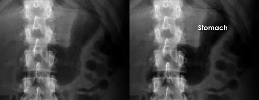 Abdominal X Ray System And Anatomy Bowel Gas Pattern   Axr Aaac 