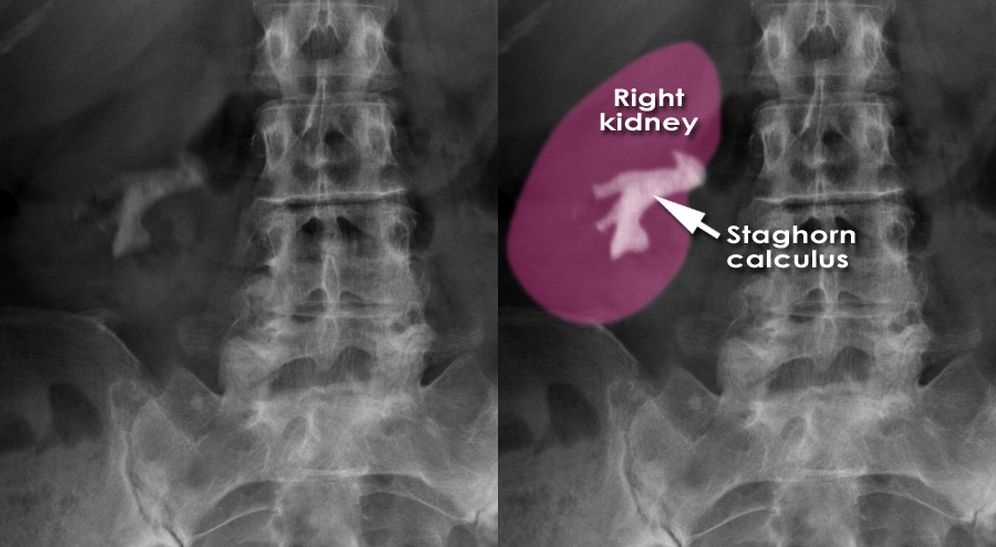kidney stones kub xray