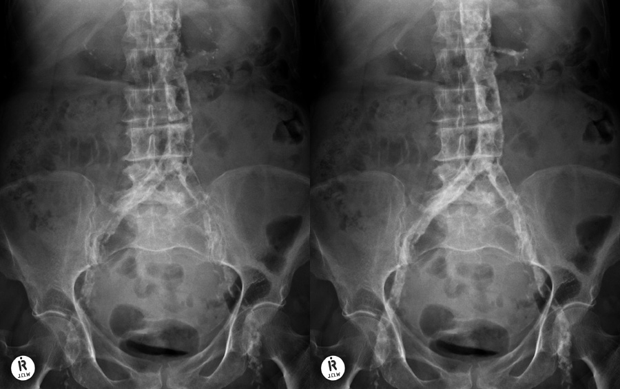 Abdominal X ray Abnormal calcification Vascular calcification