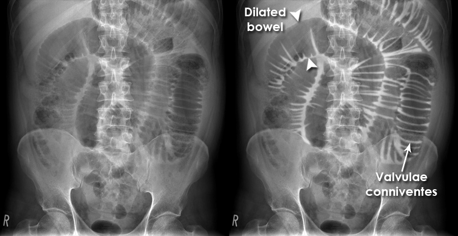 Abdominal X-ray - Abnormalities - Small Bowel Obstruction