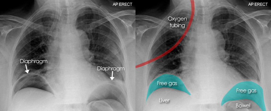 Abdominal X Ray Abnormal Bowel Gas Pattern Free Gas Pneumoperitoneum   Axr Aaba 