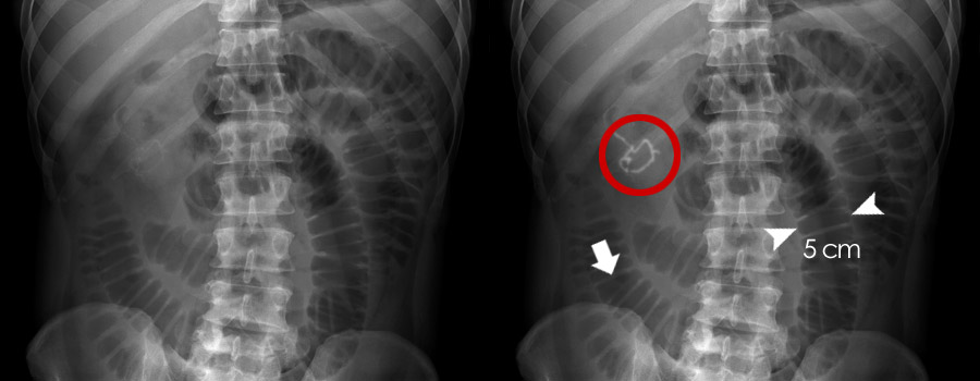 Abdominal X Ray Abnormal Bowel Gas Pattern Small Bowel Obstruction   Axr Aabk 