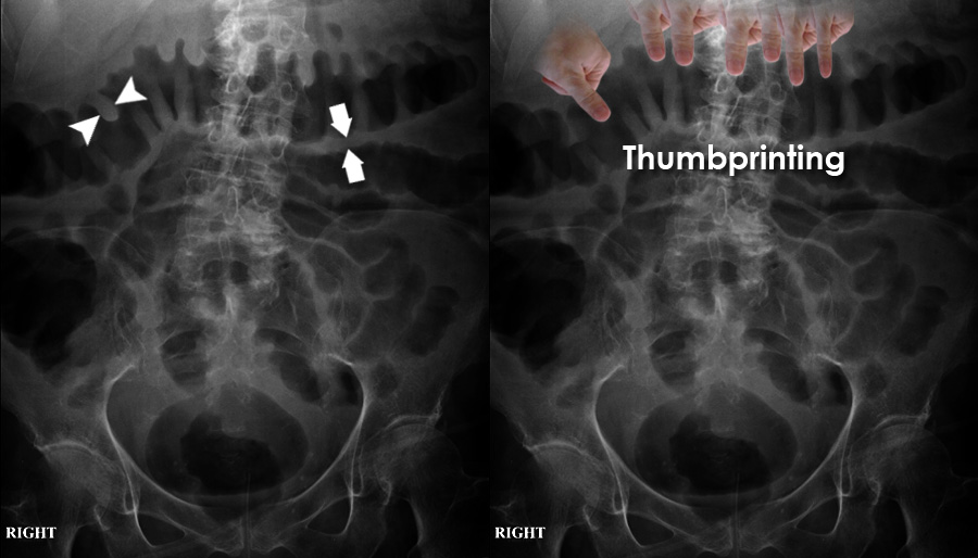 Abdominal X Ray Abnormal Bowel Gas Pattern Bowel Wall Inflammation   Axr Aabp 