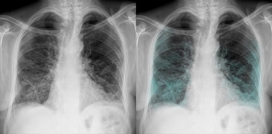 COVID-19 Image Gallery - Classification of severity