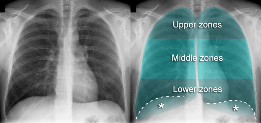 Chest X-ray Anatomy - Lung Zones