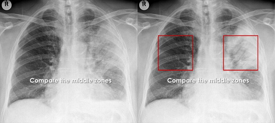 lung abscess x ray