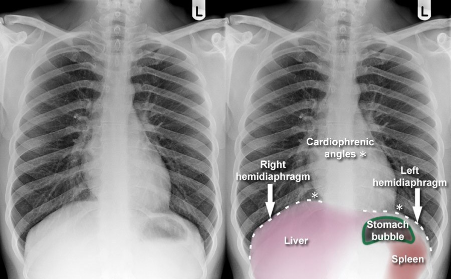 Bubbling in right 2025 side of chest