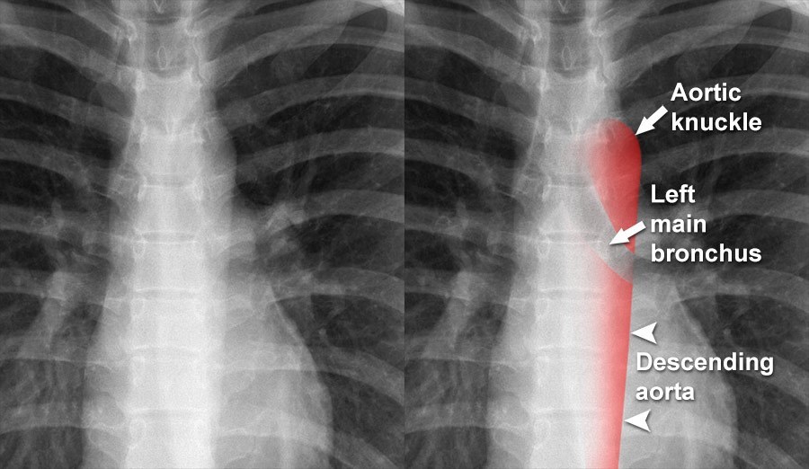 Chest X-ray Anatomy - Mediastinal Contours