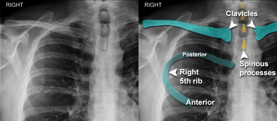 Chest X-ray Anatomy - Bones