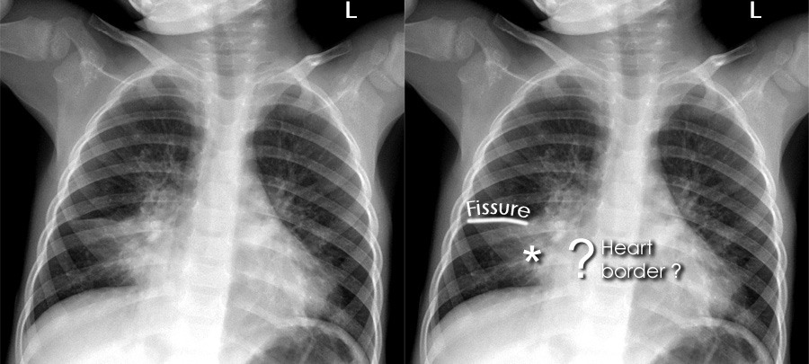 Chest X Ray Abnormalities Lobes Fissures And Contours