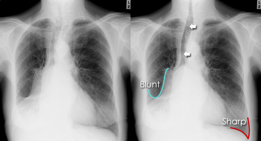 Chest X-ray Abnormalities - Costophrenic angle blunting