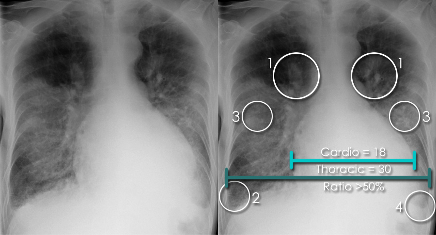 Pulmonary Edema Chest X Ray