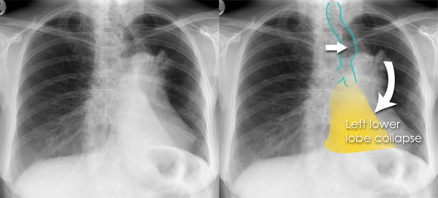 Chest X-ray - Airways and lung collapse - Left lower lobe collapse