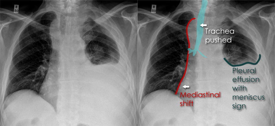 Chest X-ray - Airways and lung collapse - Large pleural effusion