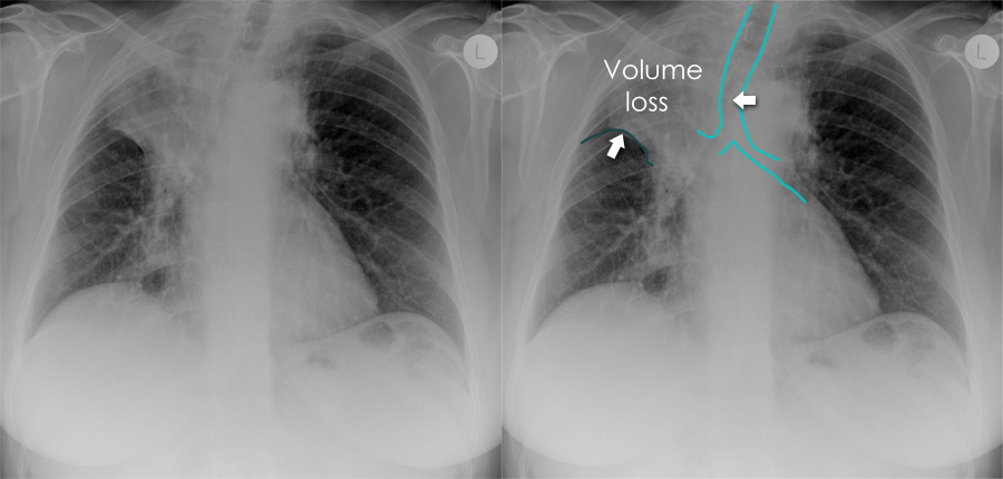 Right Middle Lobe Collapse X Ray