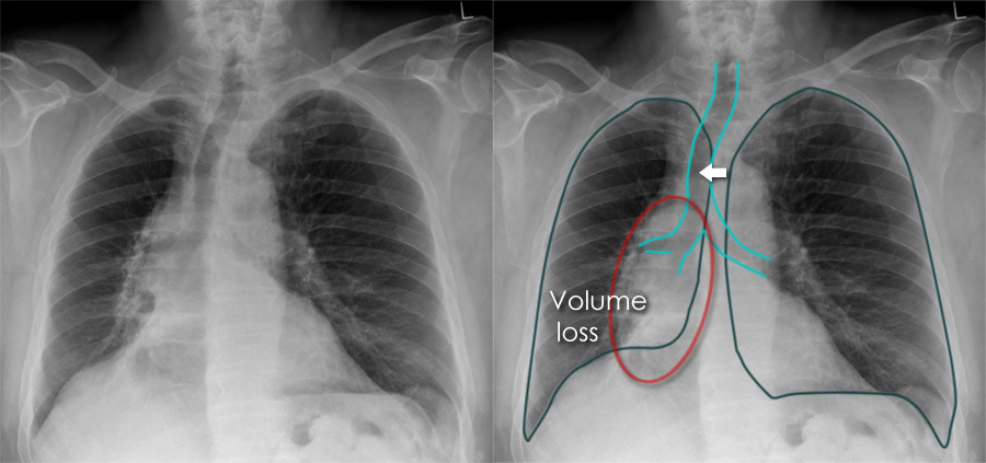 Chest X-ray - Airways and lung collapse - Right lower lobe collapse