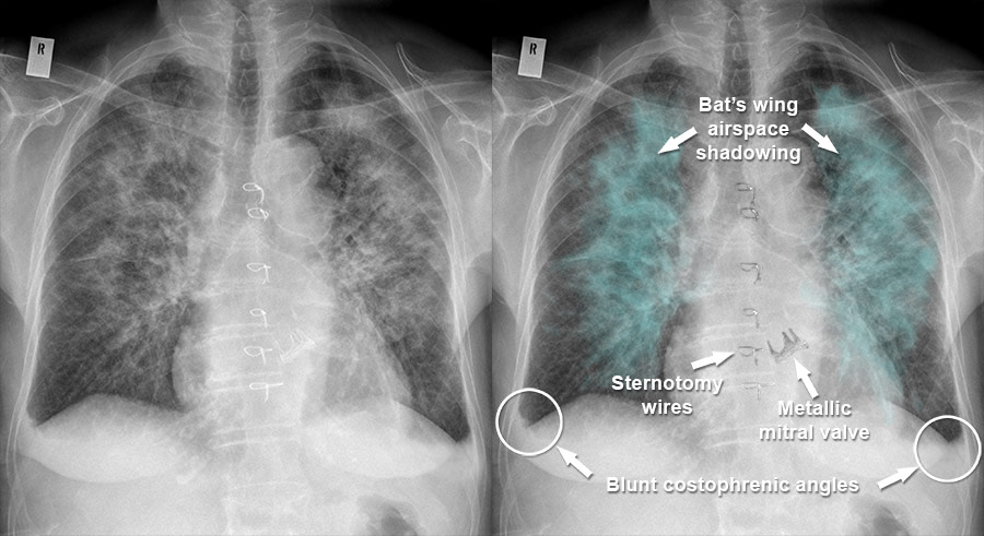 Pulmonary Edema Chest X Ray