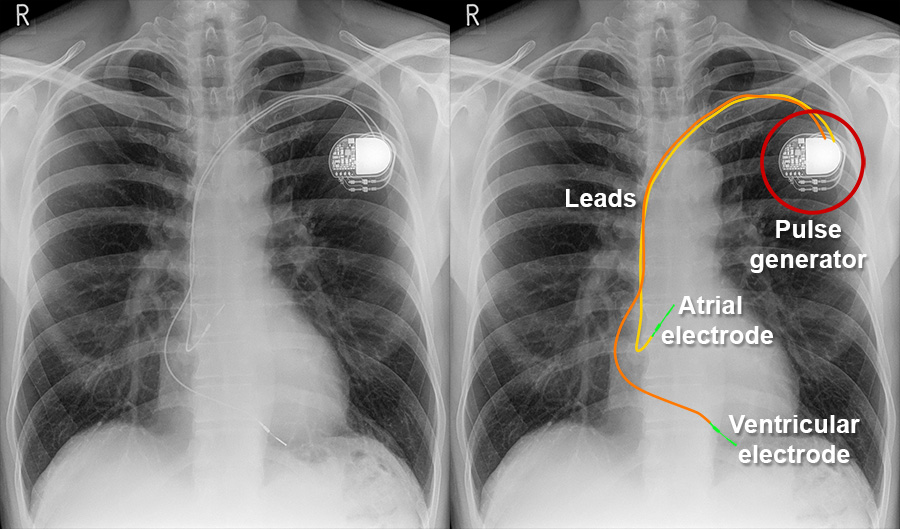 Biventricular Pacemaker Chest X Ray   Pacemaker 