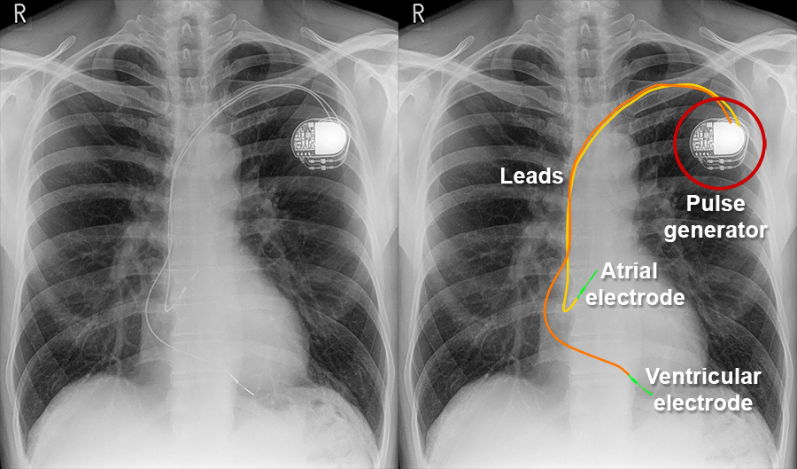 Pacemaker Chest X Ray