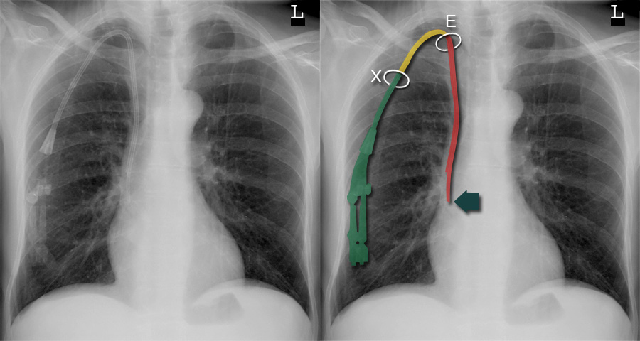 Chest X-ray - Devices and artifacts - Jugular line for chemotherapy