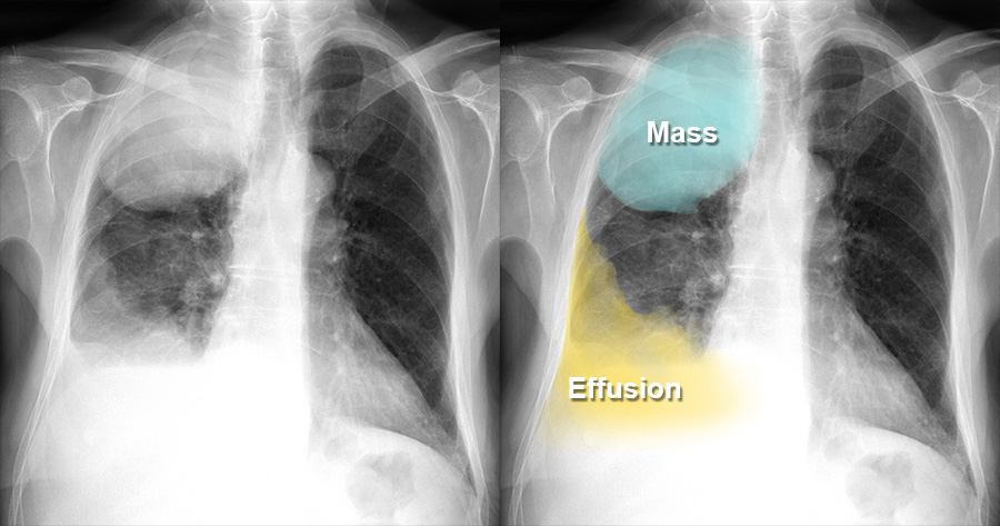 Chest X-ray - Lung Cancer - Mass V Consolidation