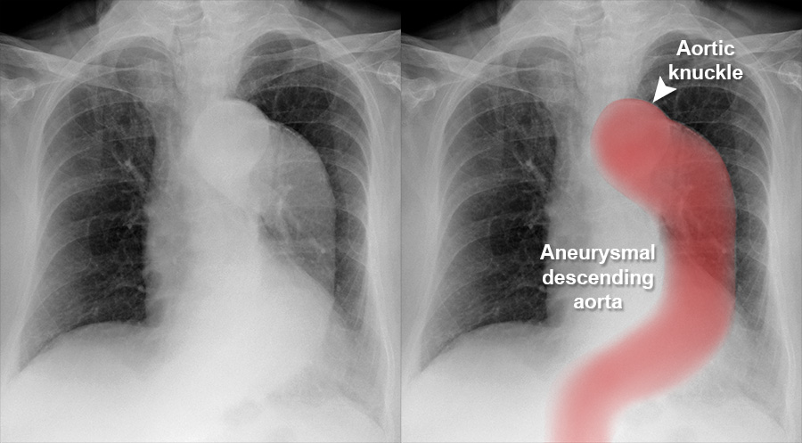aortic dissection x ray