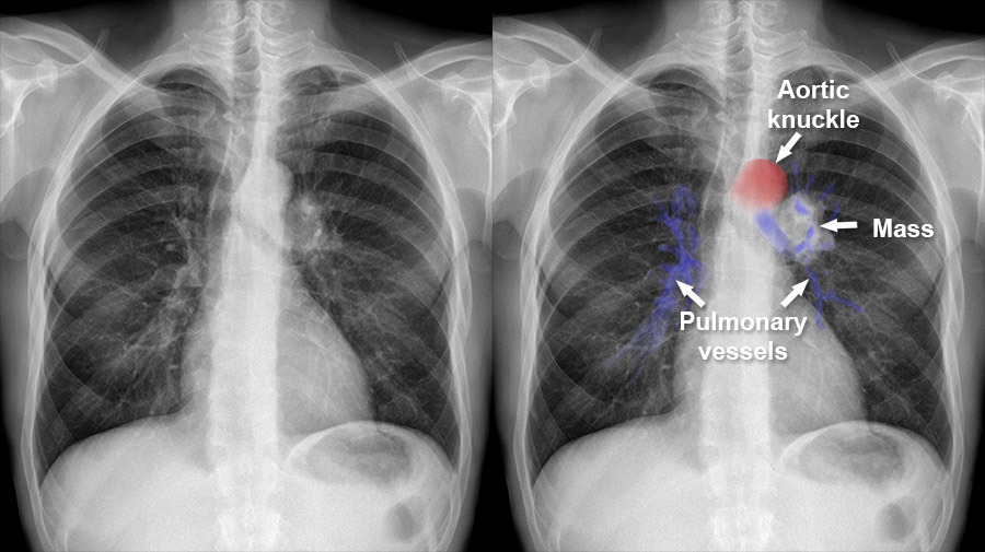 Filemediastinal Structures On Chest Xray Annotatedjpg