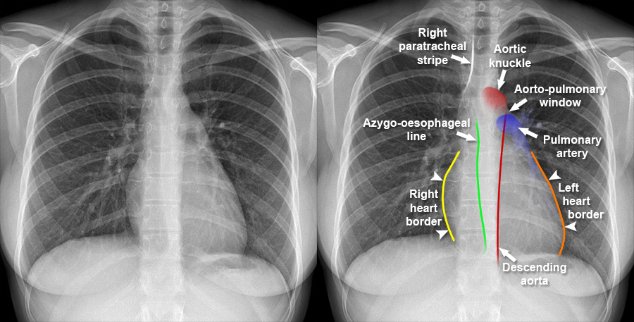 Mediastinum