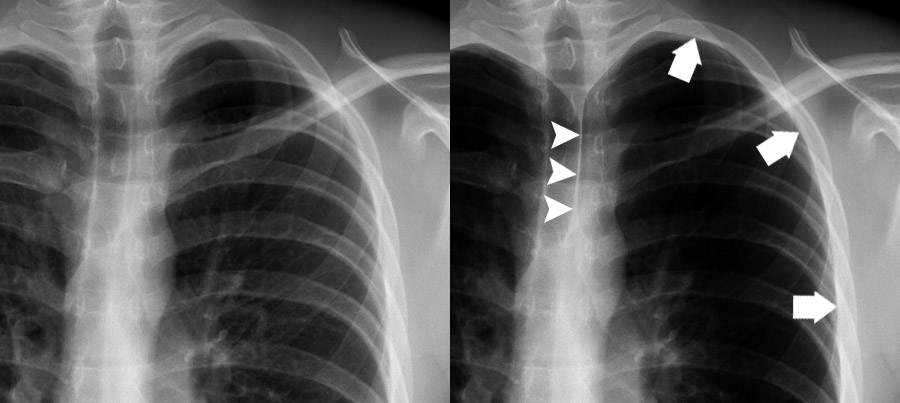Pneumothorax Vs Normal Chest X Ray