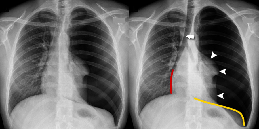 Figure Right Tension Pneumothorax Radiograph This image - StatPearls  - NCBI Bookshelf