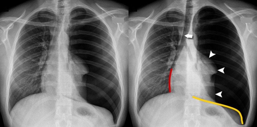 Chest X-ray - Pneumothorax gallery - Tension pneumothorax
