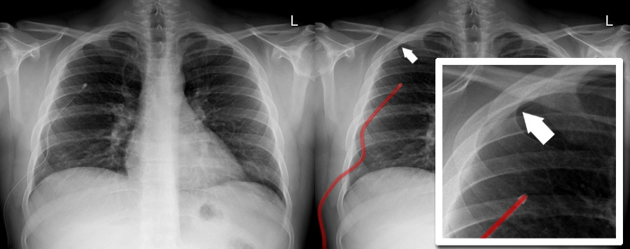 Chest X-ray - Pneumothorax gallery - Chest drain