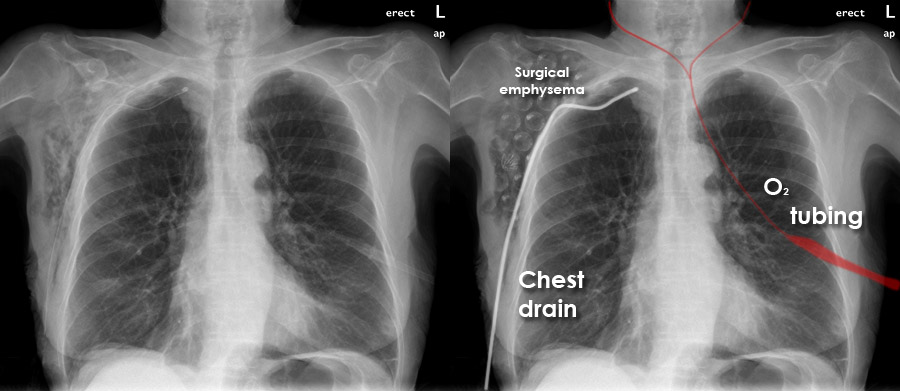 Chest X-ray - Pneumothorax gallery - Drain/surgical emphysema