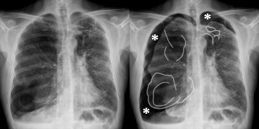 COPD Chest X Ray