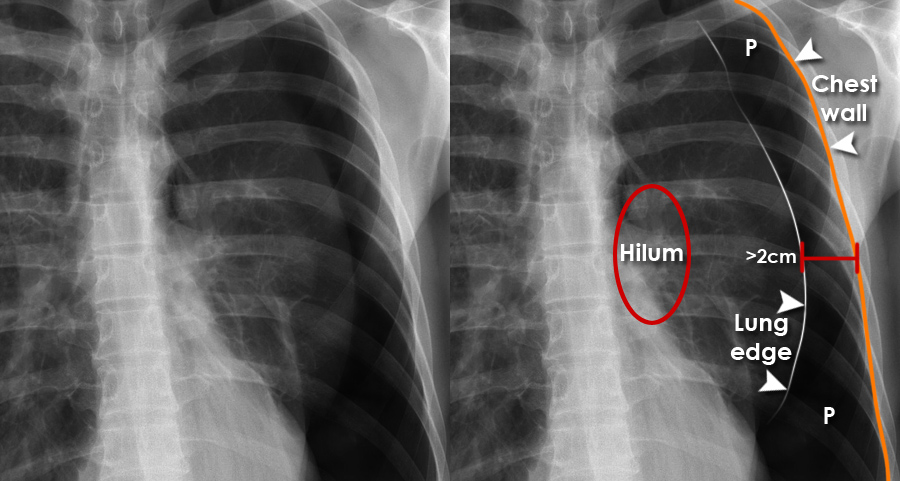 Small Pneumothorax Chest X Ray - vrogue.co