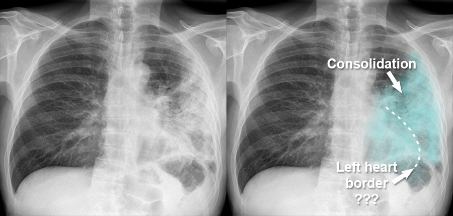 chest x ray bronchitis vs pneumonia