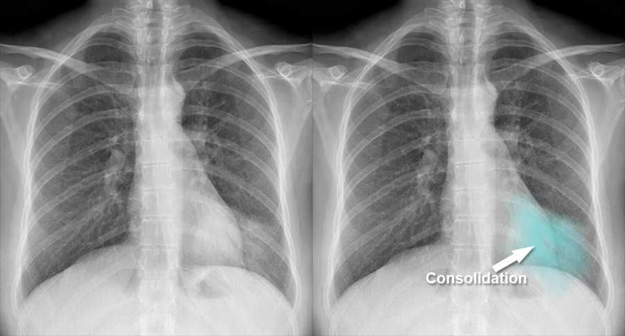pneumonia chest x ray compared to normal