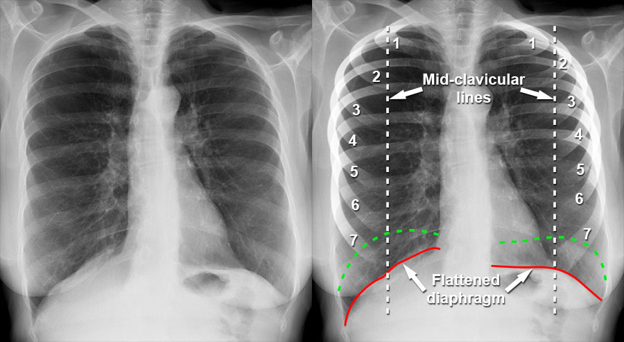 Copd On Chest X Ray