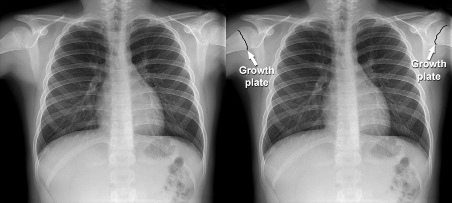 Normal Chest X Ray Labeled