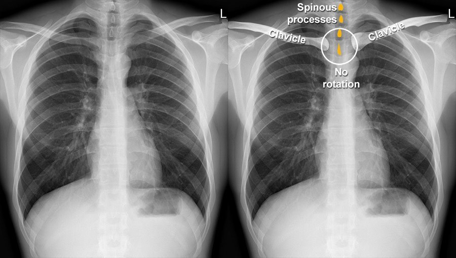 Normal Chest X Ray Images