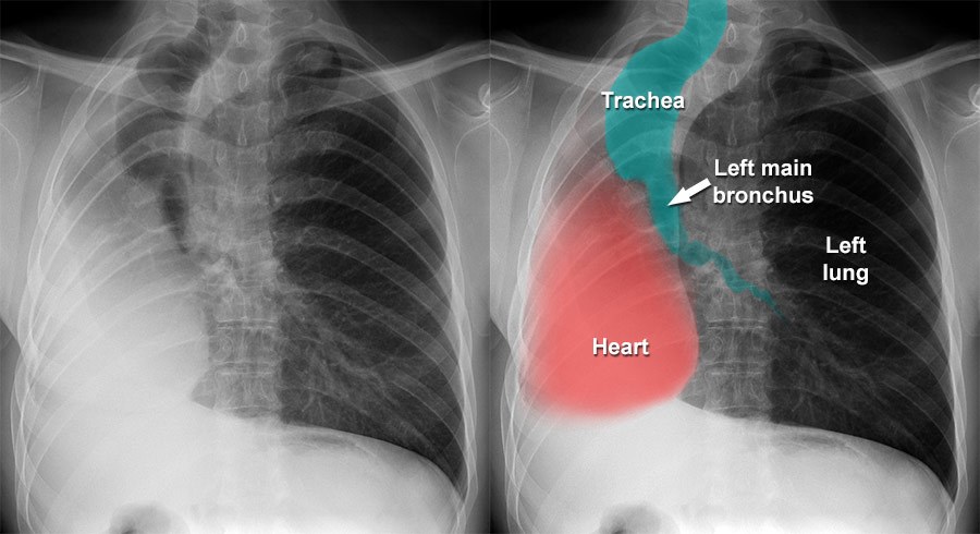 Chest X-ray - Quality - Normal chest X-ray - post-surgical