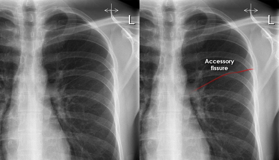 Chest X-ray - Anatomical variants - Accessory fissure