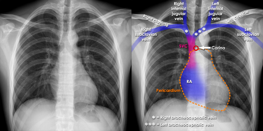 Chest X Ray Confirming The Position Of The Central Ve - vrogue.co
