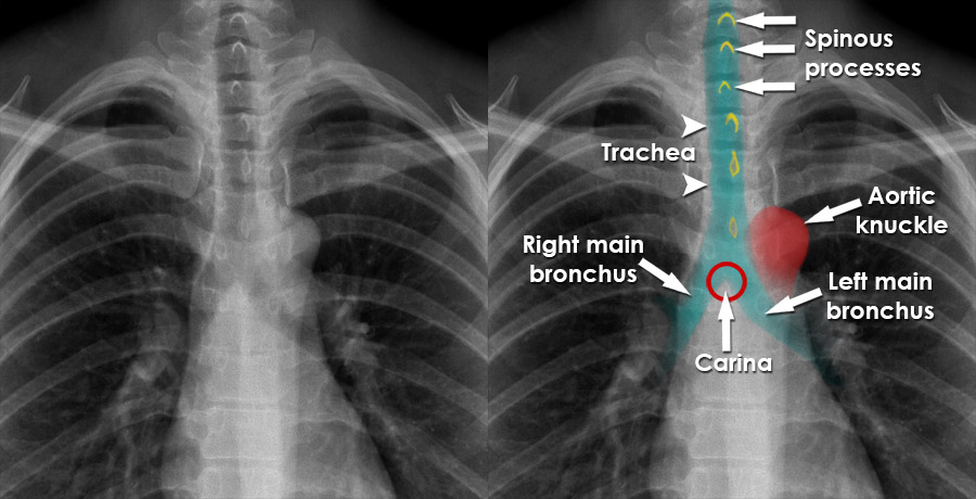 Endotracheal Tube Placement X Ray