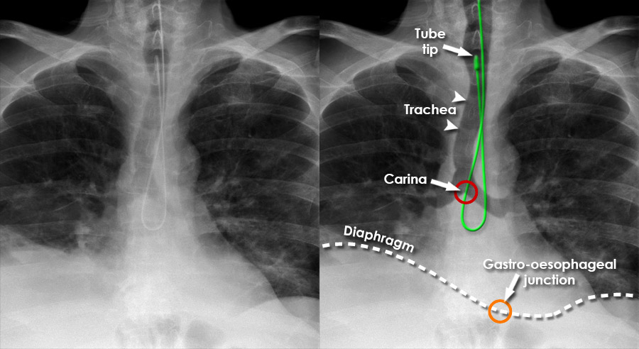 Chest X-ray - Tubes - NG Tubes - Complications