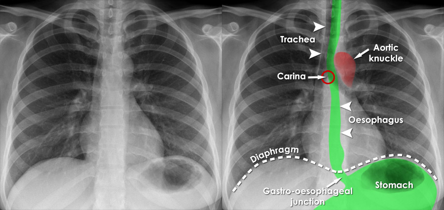 Chest X Ray Showing Right Sided Chest Tube Placement - vrogue.co