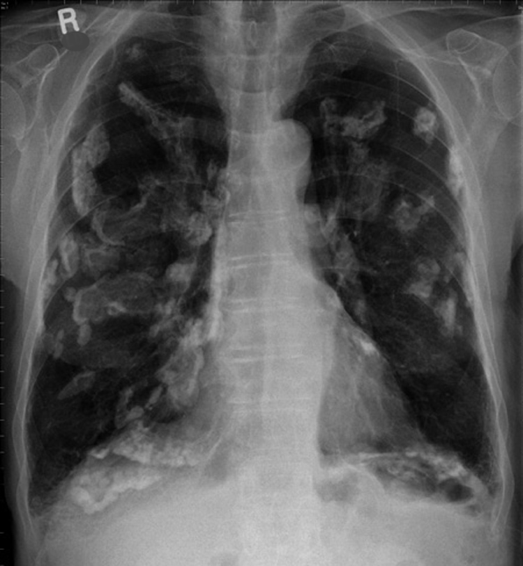 chest infection x ray findings