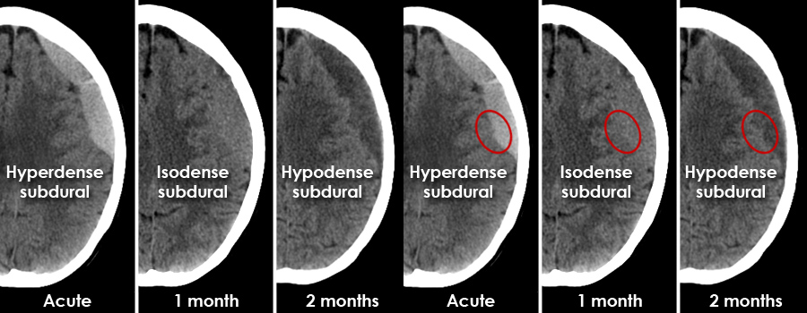 chronic subdural hematoma vs acute