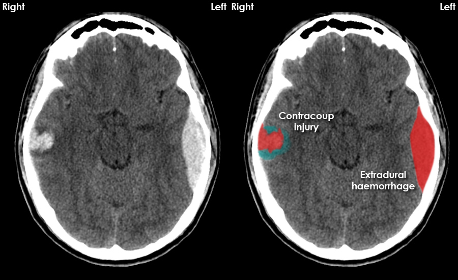 CT brain image gallery - SAH